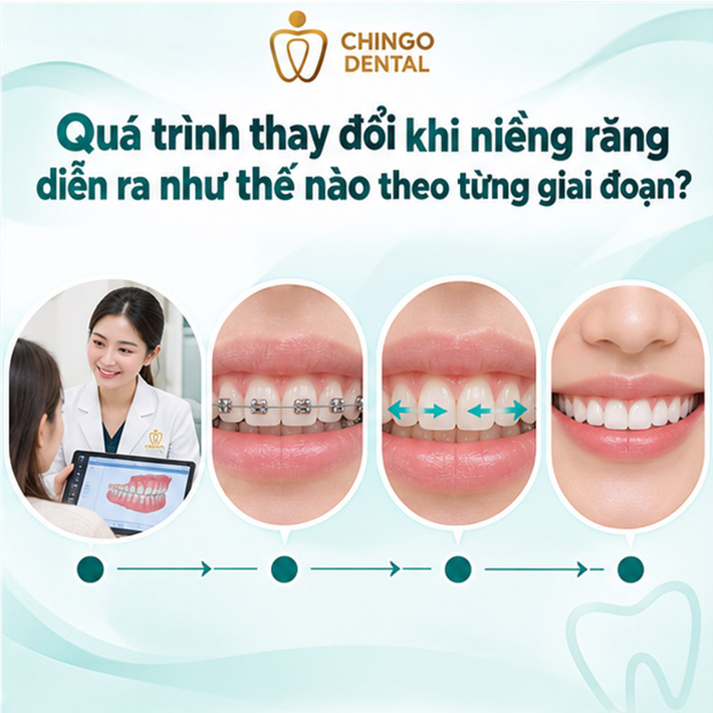 Quá Trình Thay Đổi Khi Niềng Răng: Hành Trình Từ Trước Và Sau Mà Bạn Cần Biết 2 trước và sau khi niềng răng