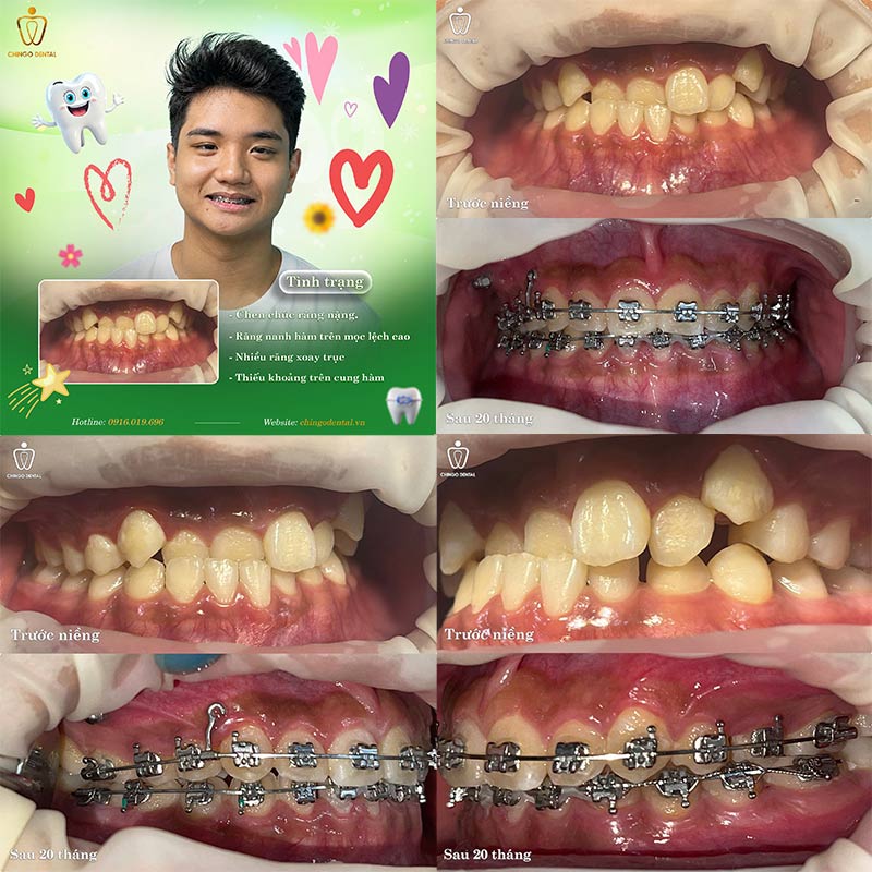 Quá Trình Thay Đổi Khi Niềng Răng: Hành Trình Từ Trước Và Sau Mà Bạn Cần Biết 5 trước và sau niềng răng
